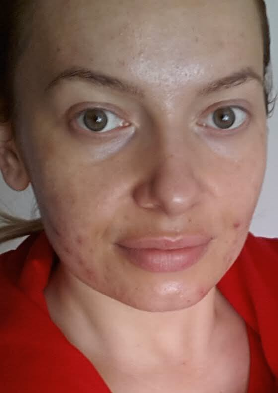 Ewelina przed, 28 lat, widoczny trądzik i zaczerwienienie